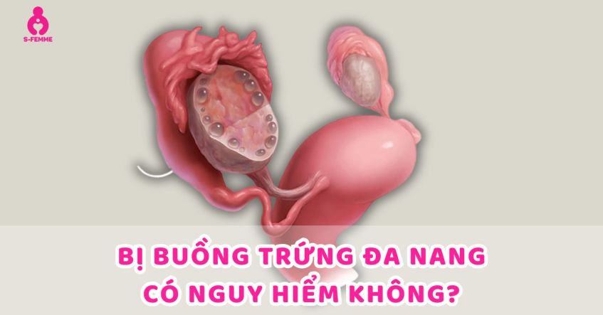 Bị đa nang buồng trứng có nguy hiểm không​? Giải đáp chi tiết