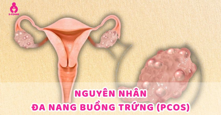 Giải thích: Nguyên nhân tại sao bị đa nang buồng trứng?