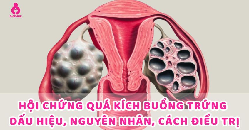 Hội chứng quá kích buồng trứng​ là gì? Dấu hiệu, Nguyên Nhân, Cách điều trị