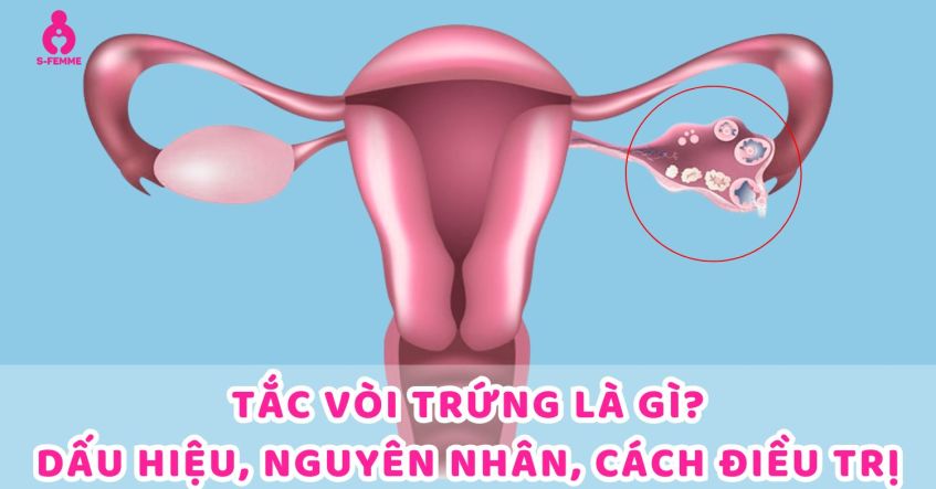 Tắc vòi trứng là gì? Dấu hiệu, Nguyên Nhân, Cách điều trị