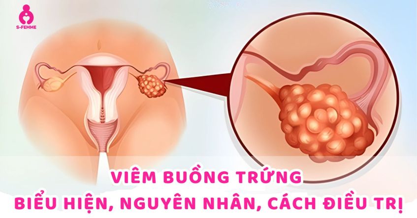 Viêm buồng trứng là gì? Biểu hiện, Nguyên nhân, Cách điều trị