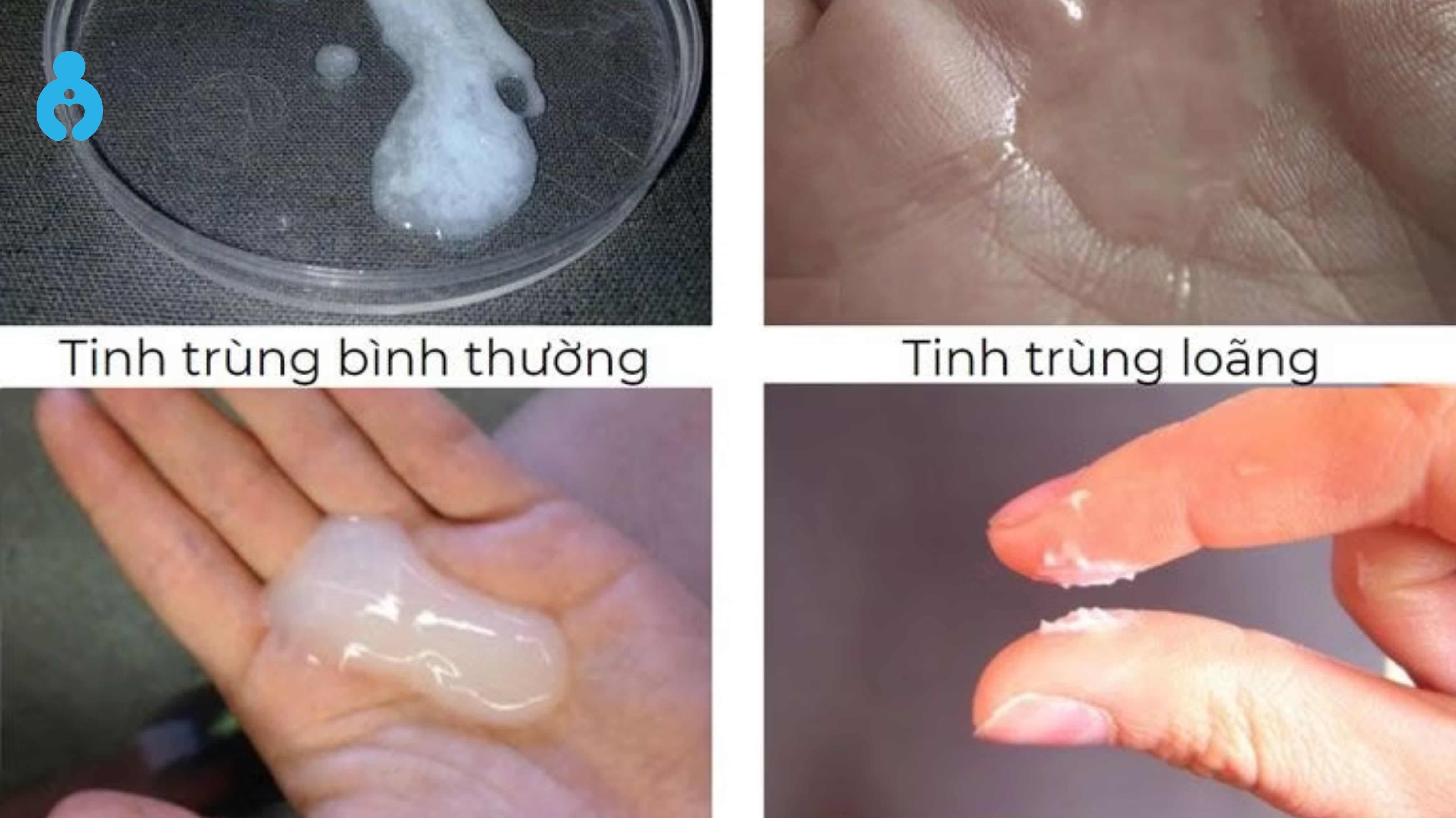 Dấu hiệu tinh trùng ít và loãng
