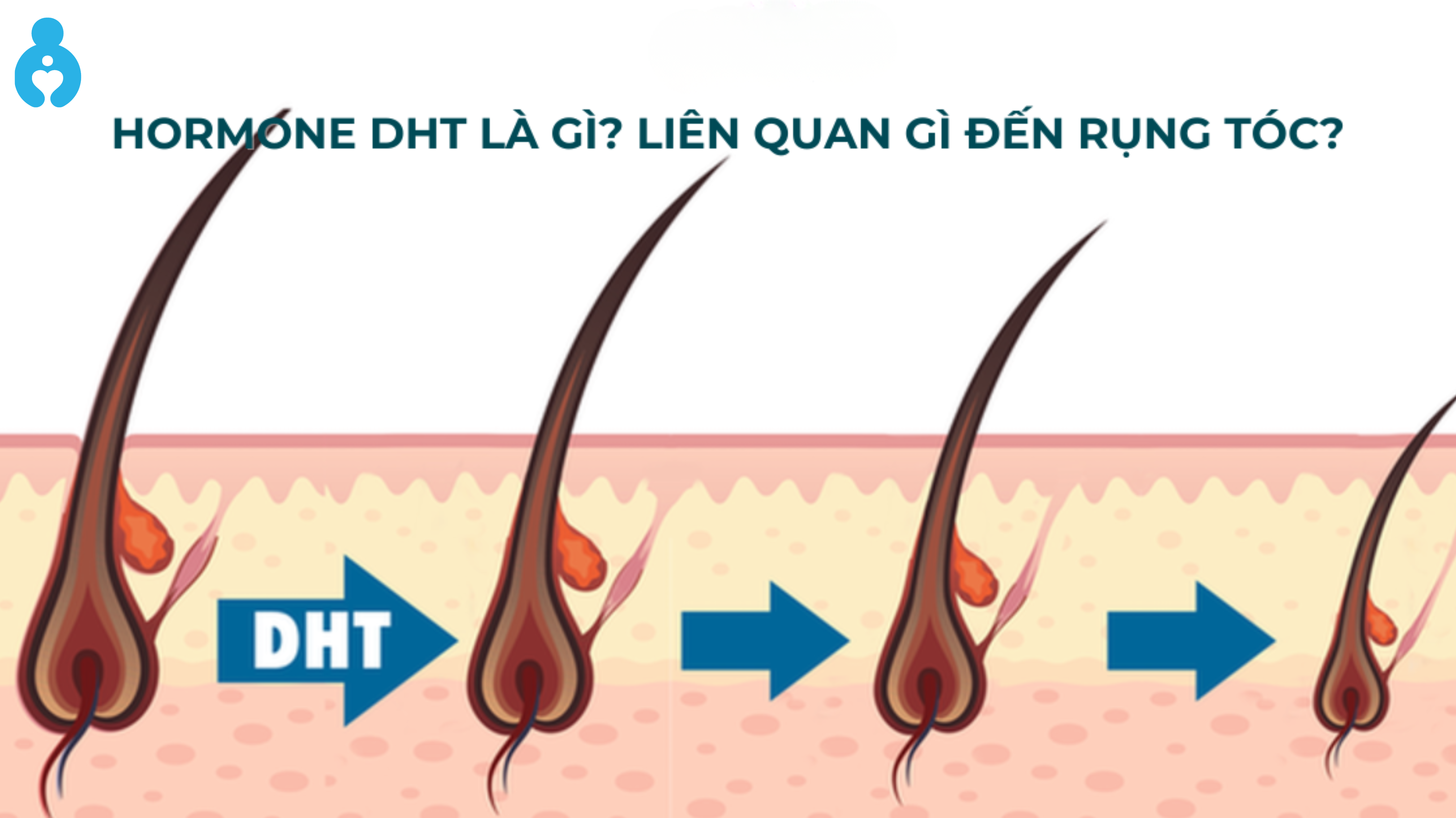 Mối liên hệ giữa testosterone, DHT và rụng tóc nam giới