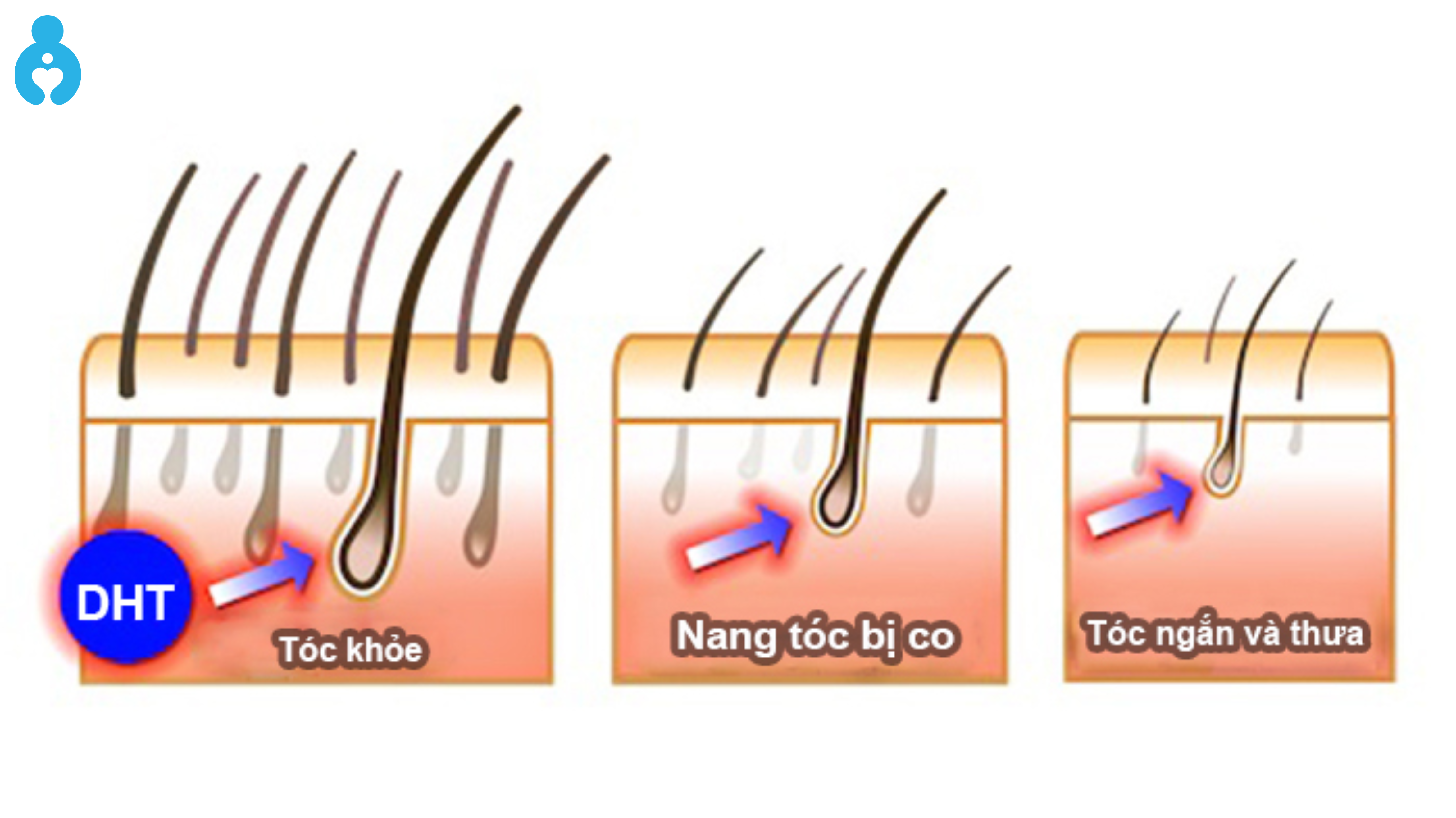 Nguyên nhân rụng tóc ở nam giới