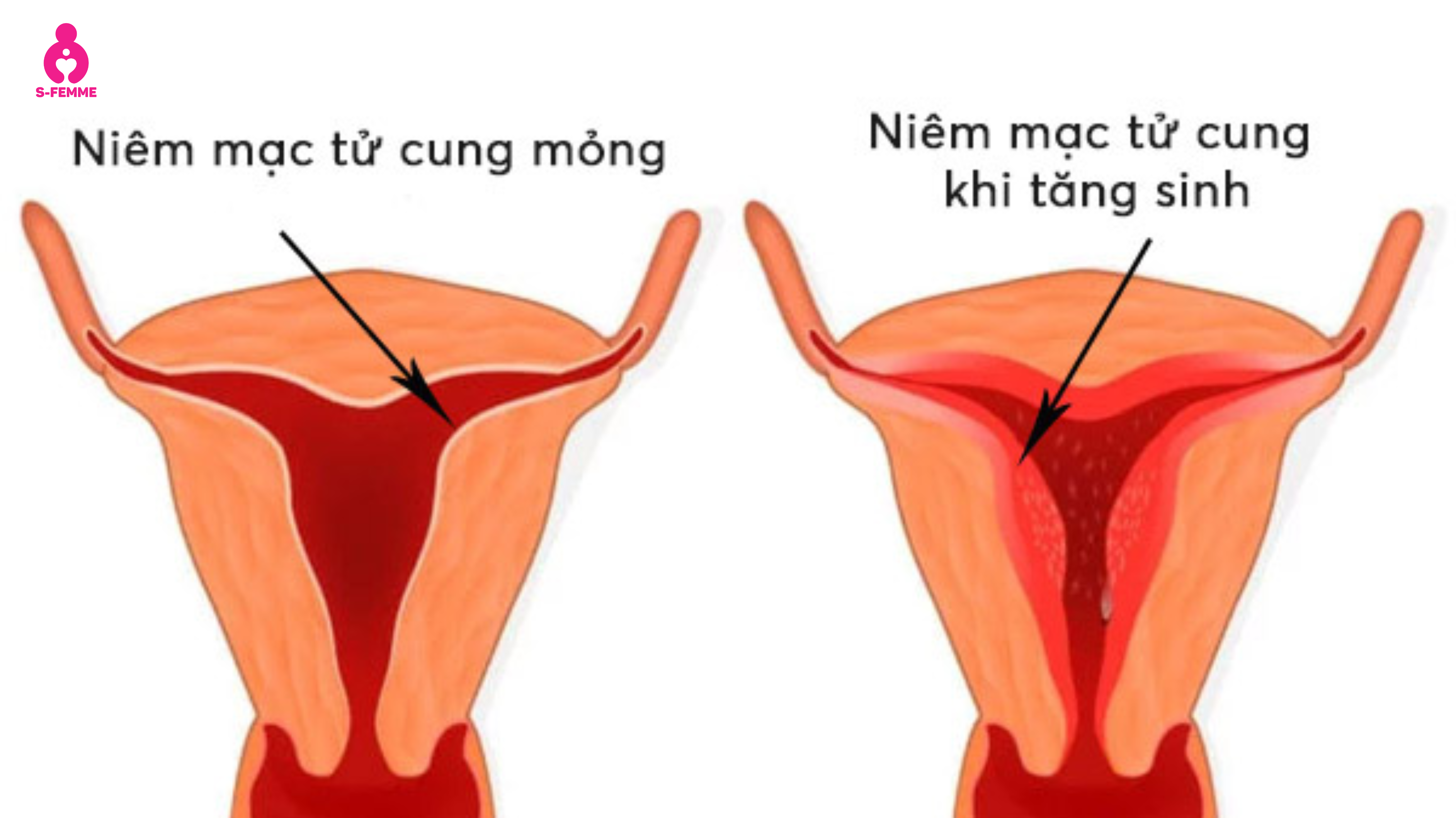 Niêm mạc tử cung mỏng là gì_ Bao nhiêu mm được xem là mỏng