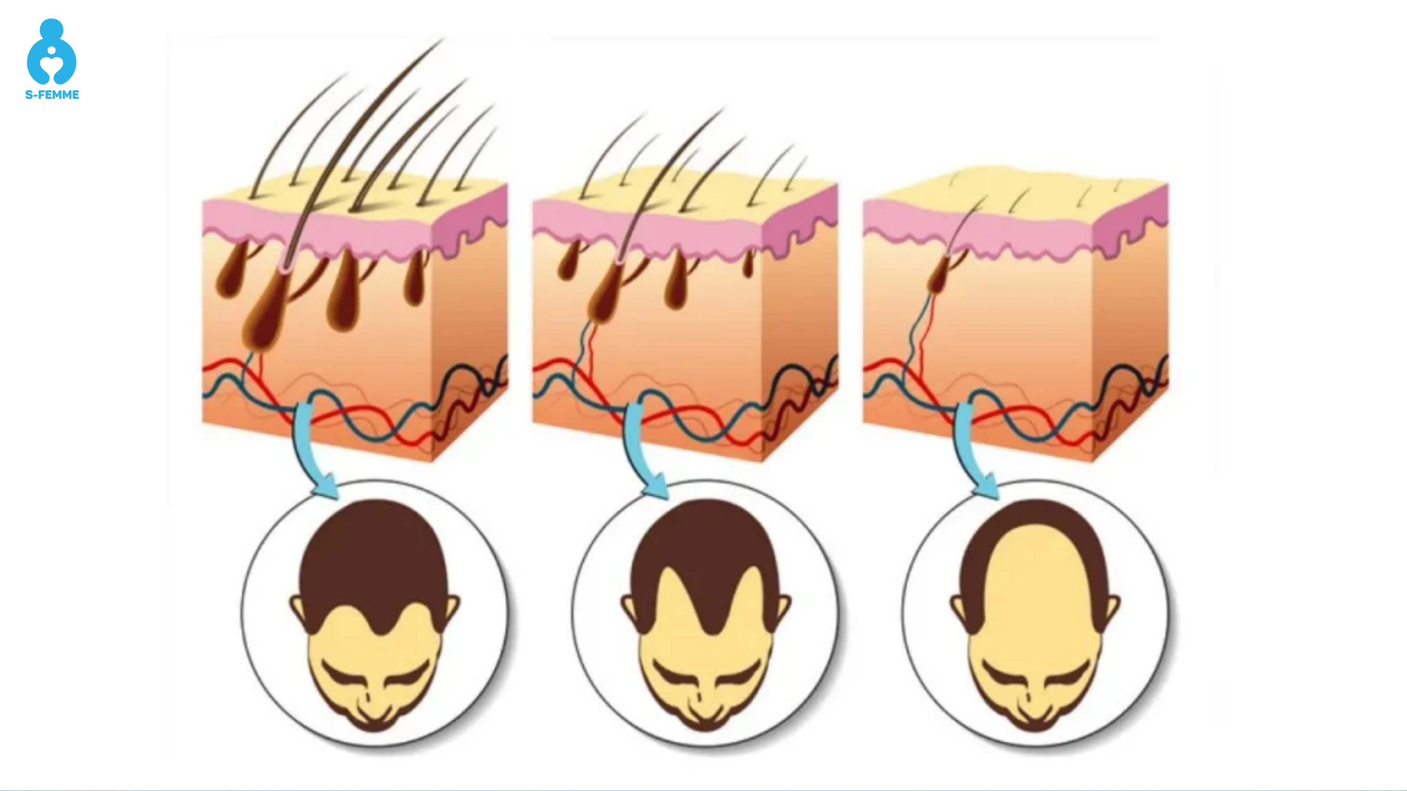 Testosterone và DHT ảnh hưởng đến tóc như thế nào