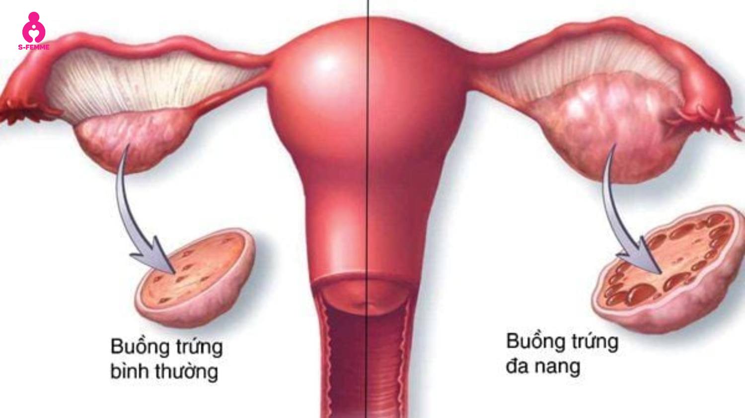 a nang buồng trứng 1 bên