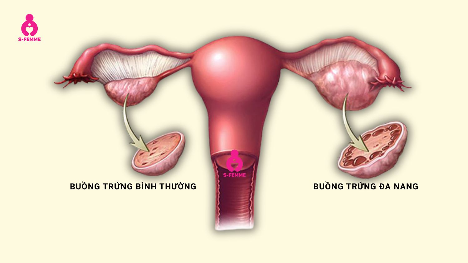 Bài tập Yoga dưỡng trứng tốt cho người mắc PCOS