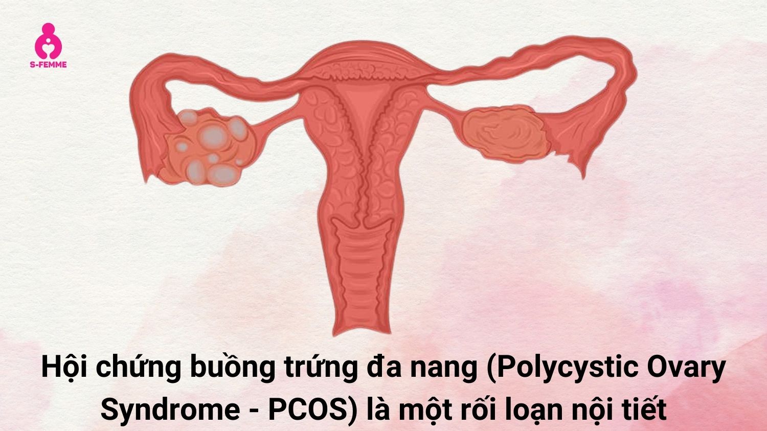 Tìm hiểu hội chứng buồng trứng đa nang (PCOS) là gì?