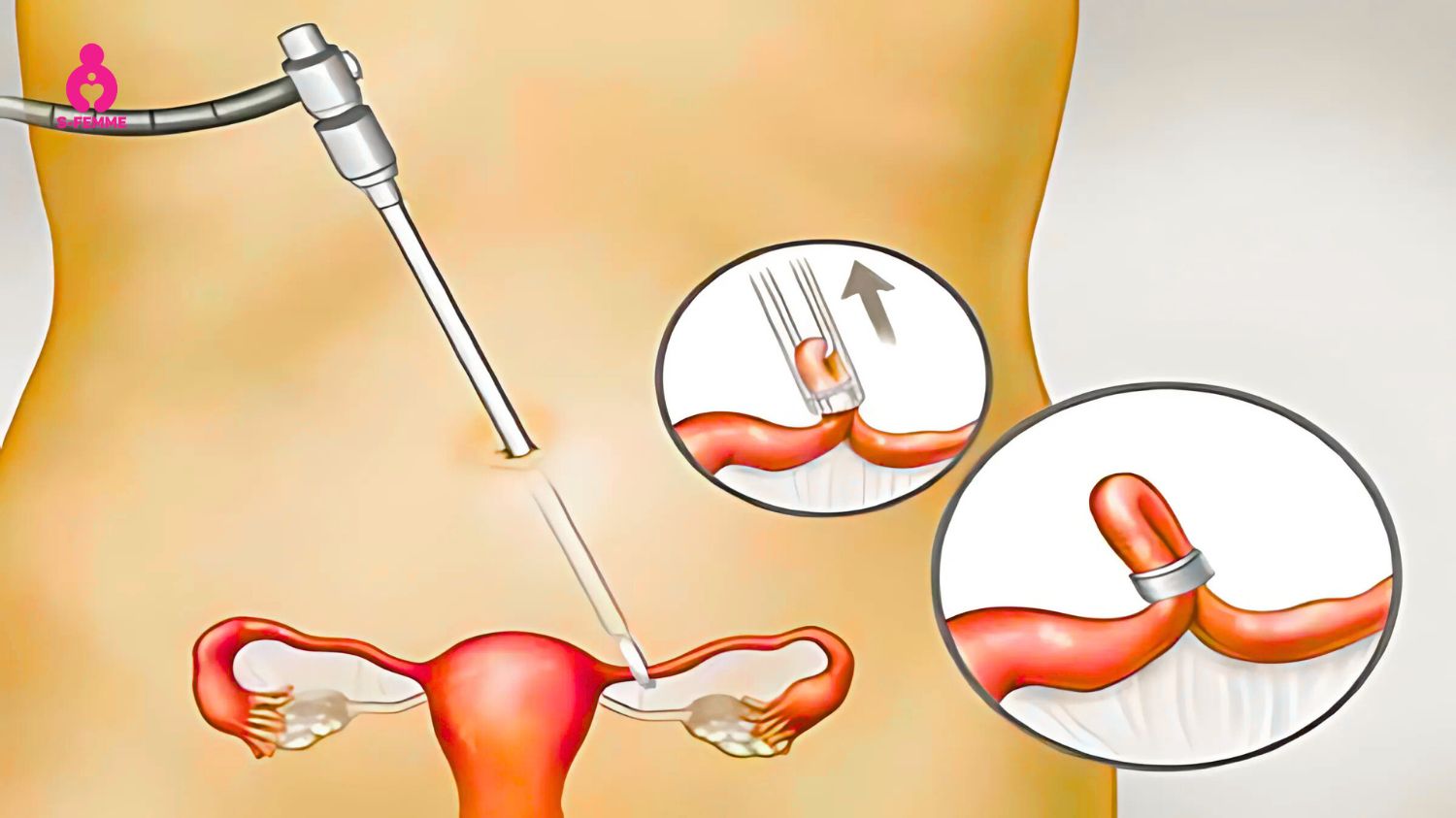 Phẫu thuật nội soi là phương án điều trị tắc vòi trứng hiệu quả